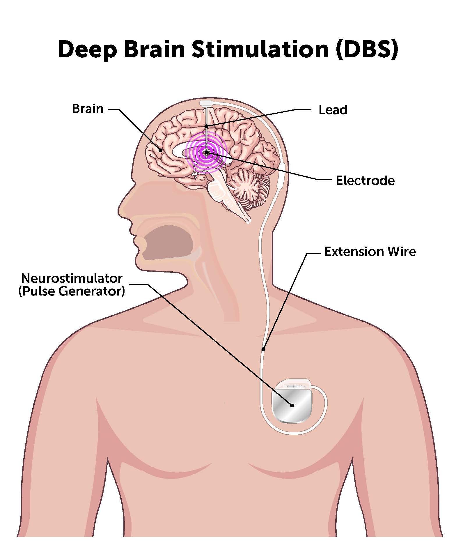 3D Software To Improve Success Of DBS Surgery Parkinsons NSW